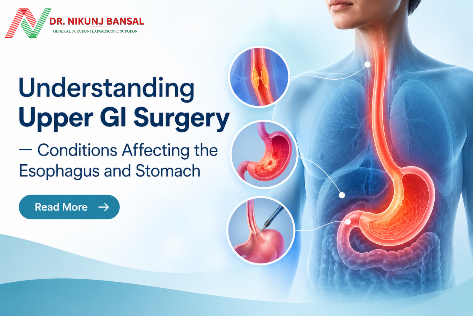 Understanding Upper GI Surgery — Conditions Affecting the Esophagus and Stomach